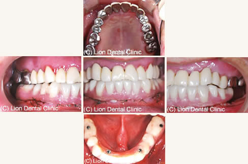 All On 4 オールオン4 東京 神奈川のインプラント治療はライオンインプラントセンターへ