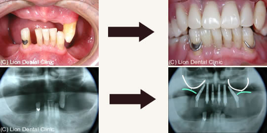 All On 4 オールオン4 東京 神奈川のインプラント治療はライオンインプラントセンターへ