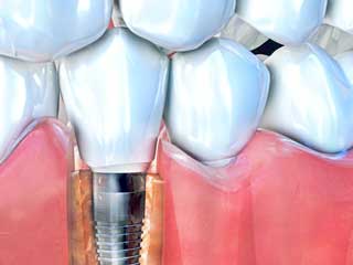 噛みしめるインプラント